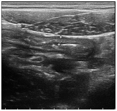 Case Report: Simil-Appendicitis Presentation May Precede Cardiac Involvement in MIS-C Patient